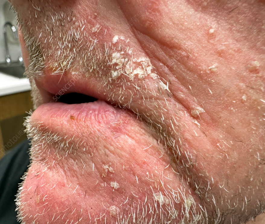 Seborrheic Eczema Face Seborrheic Eczema Face