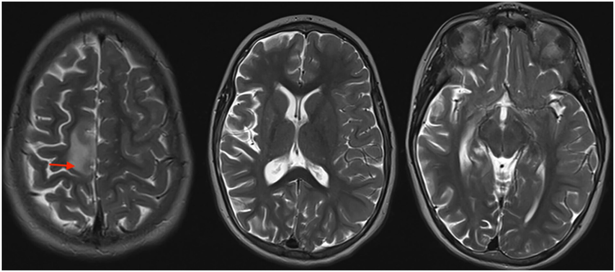 Nels Rasmussen For a general audience: Understanding Rasmussen's Encephalitis: A ...